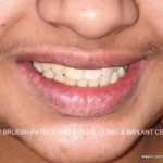 After Braces smile Corrected align teeth