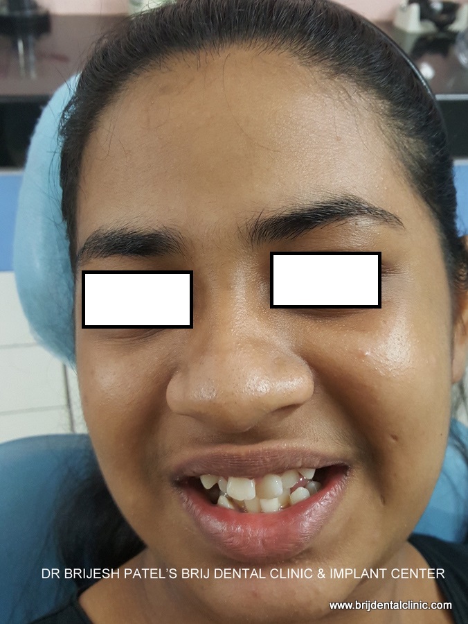 Before Braces smile, irregular teeth