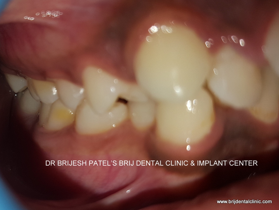Mal occlusion with uneven teeth