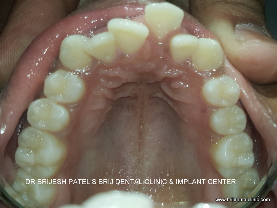 Irregularly placed Upper teeth, crowding and uneven teeth