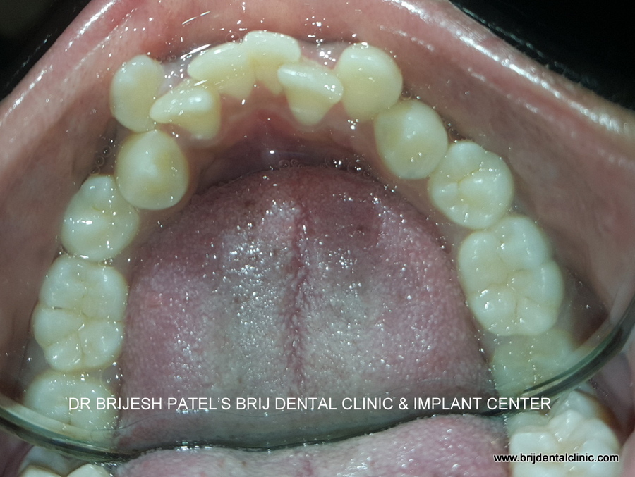 Irregularly placed lower teeth, crowding and uneven teeth