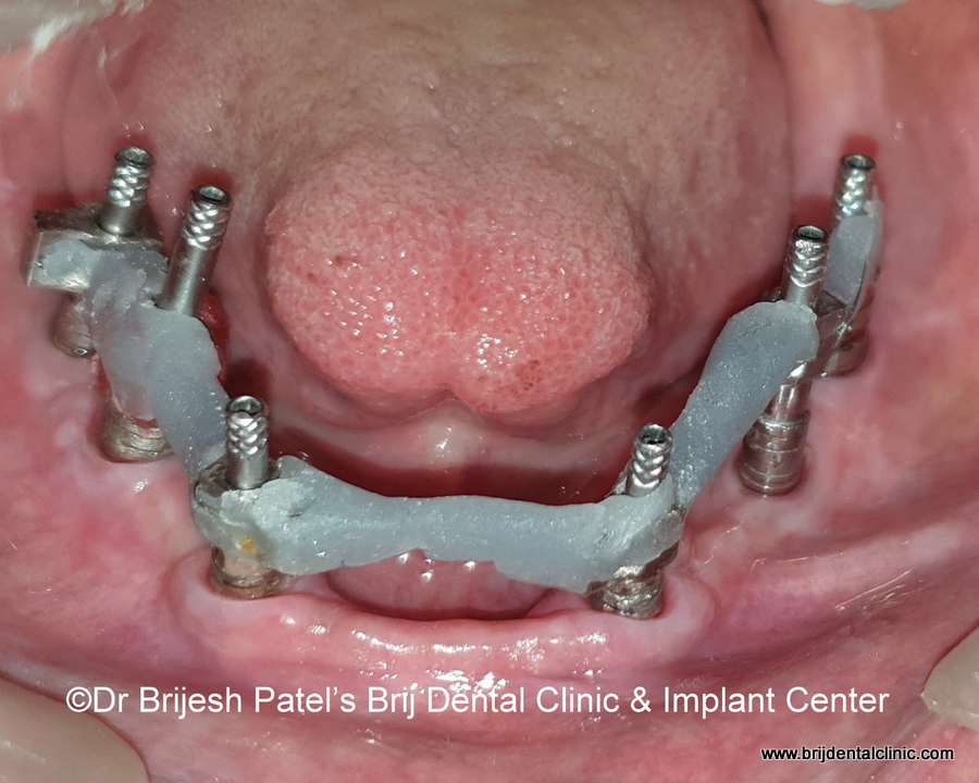 Implant Impression Posts Connected for Indirect Impression