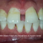 Gap Teeth,Diastema in teeth