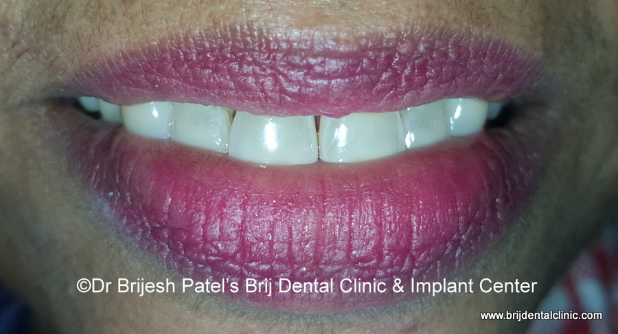 Smile after clear aligner treatment