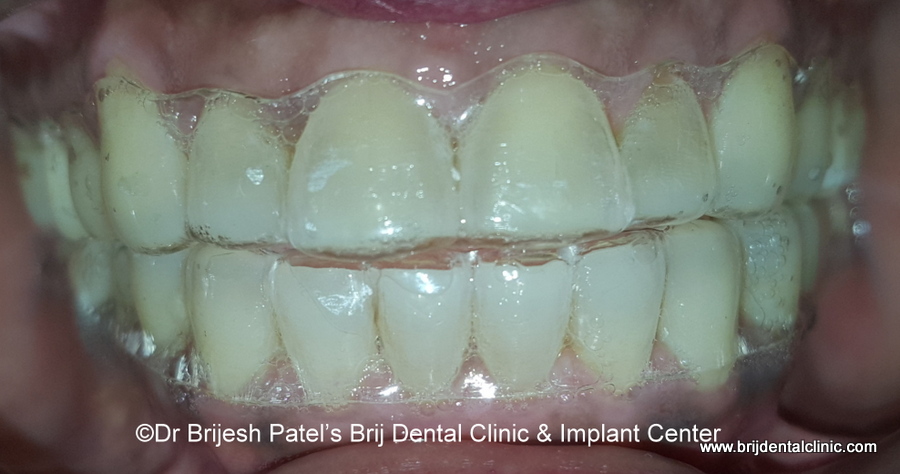 Clear Aligner on Teeth, invisible and transperant