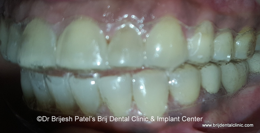 Clear Aligner on Teeth, invisible and transperant