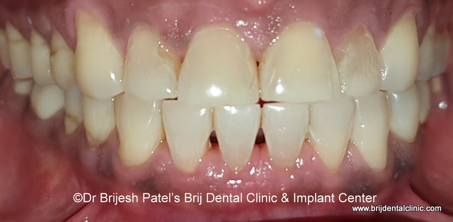 Result after Openbite correction with Clear aligners, Clear braces