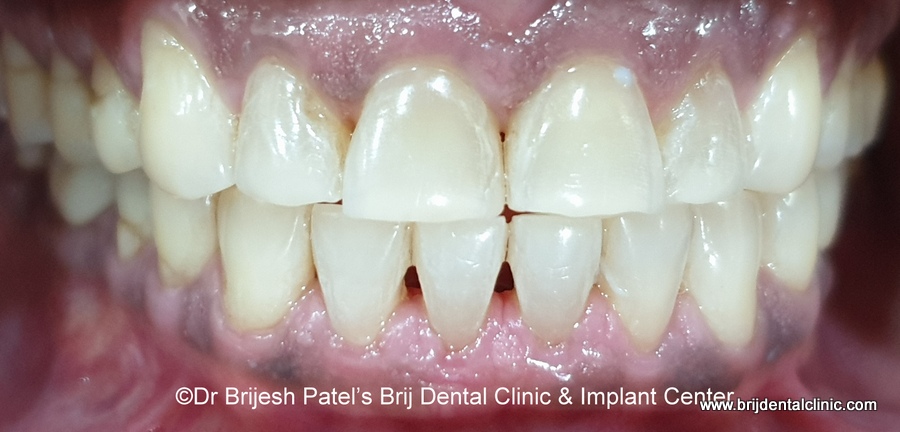 After Clear aligner, smile no gap perfect aligned teeth