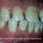 Proclined andgap teeth, before aligner treatment