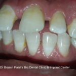 Proclined andgap teeth, before aligner treatment