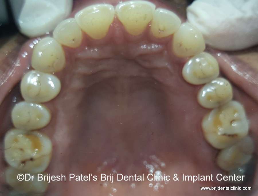 Aligned teeth after aligners treatment