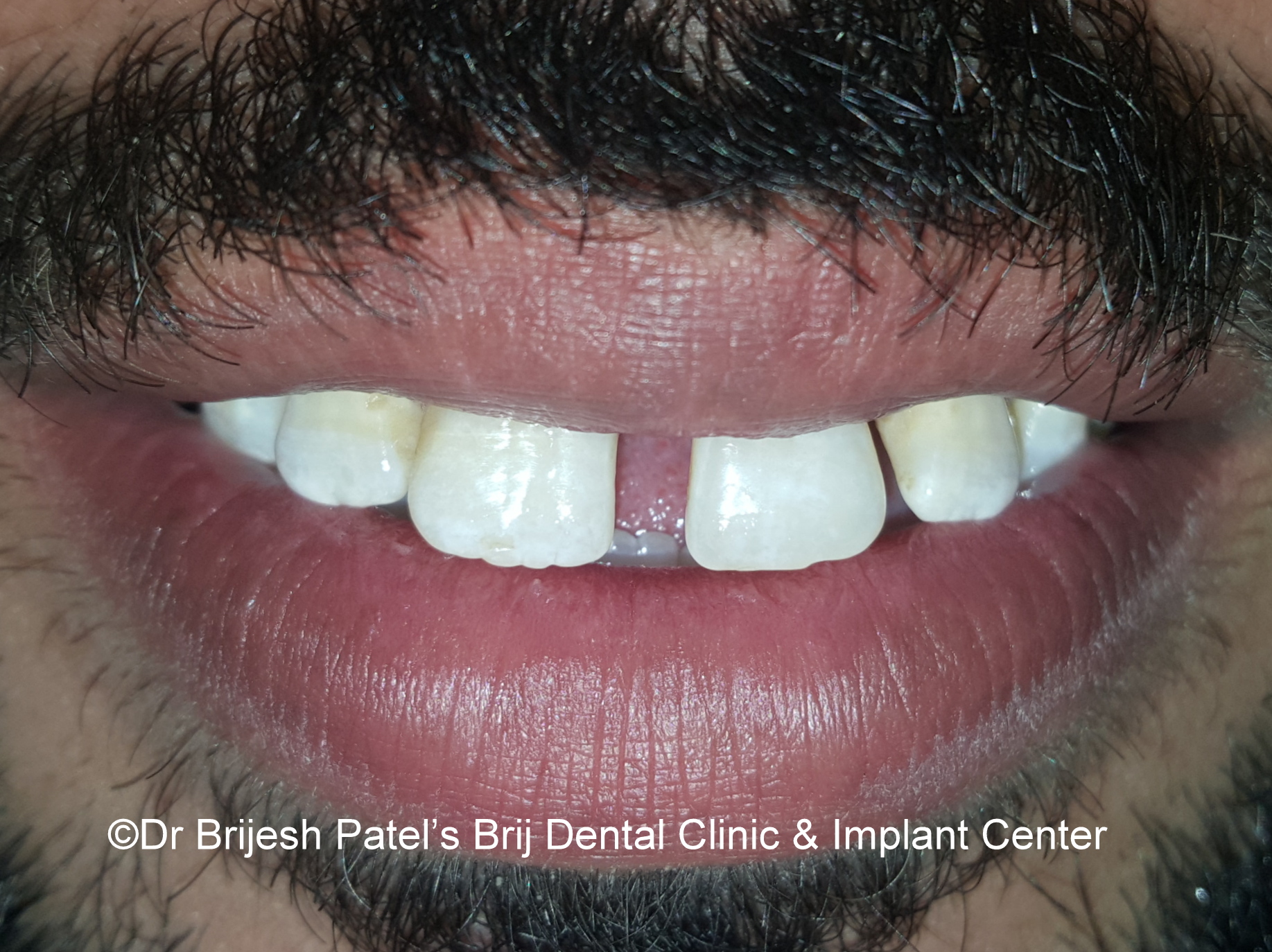 Smile with gap teeth before treatment