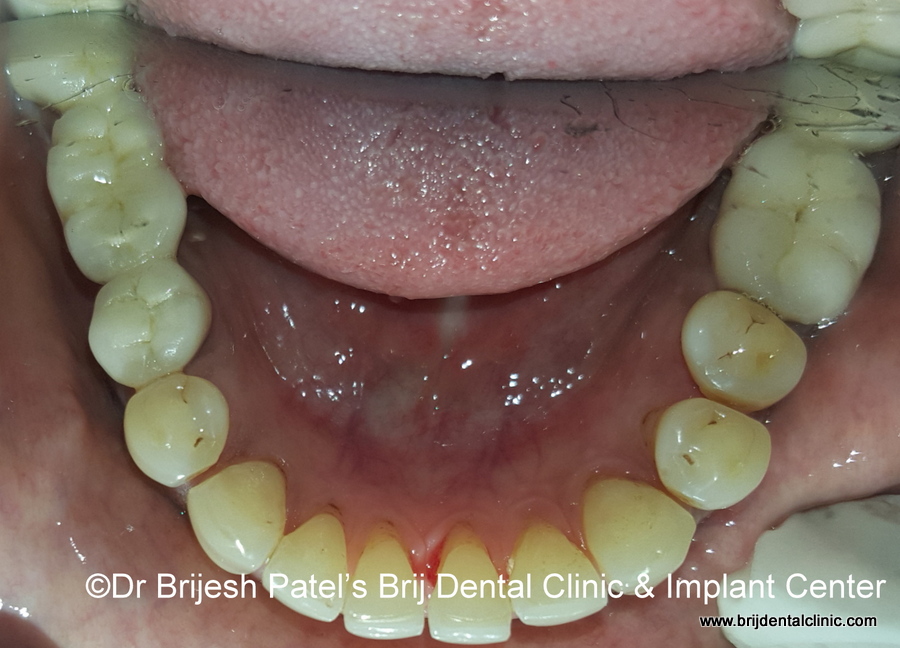 Aligned teeth after aligners treatment