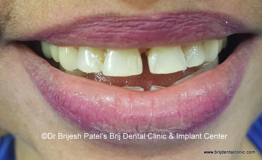 Smile with Gap teeth before treatment