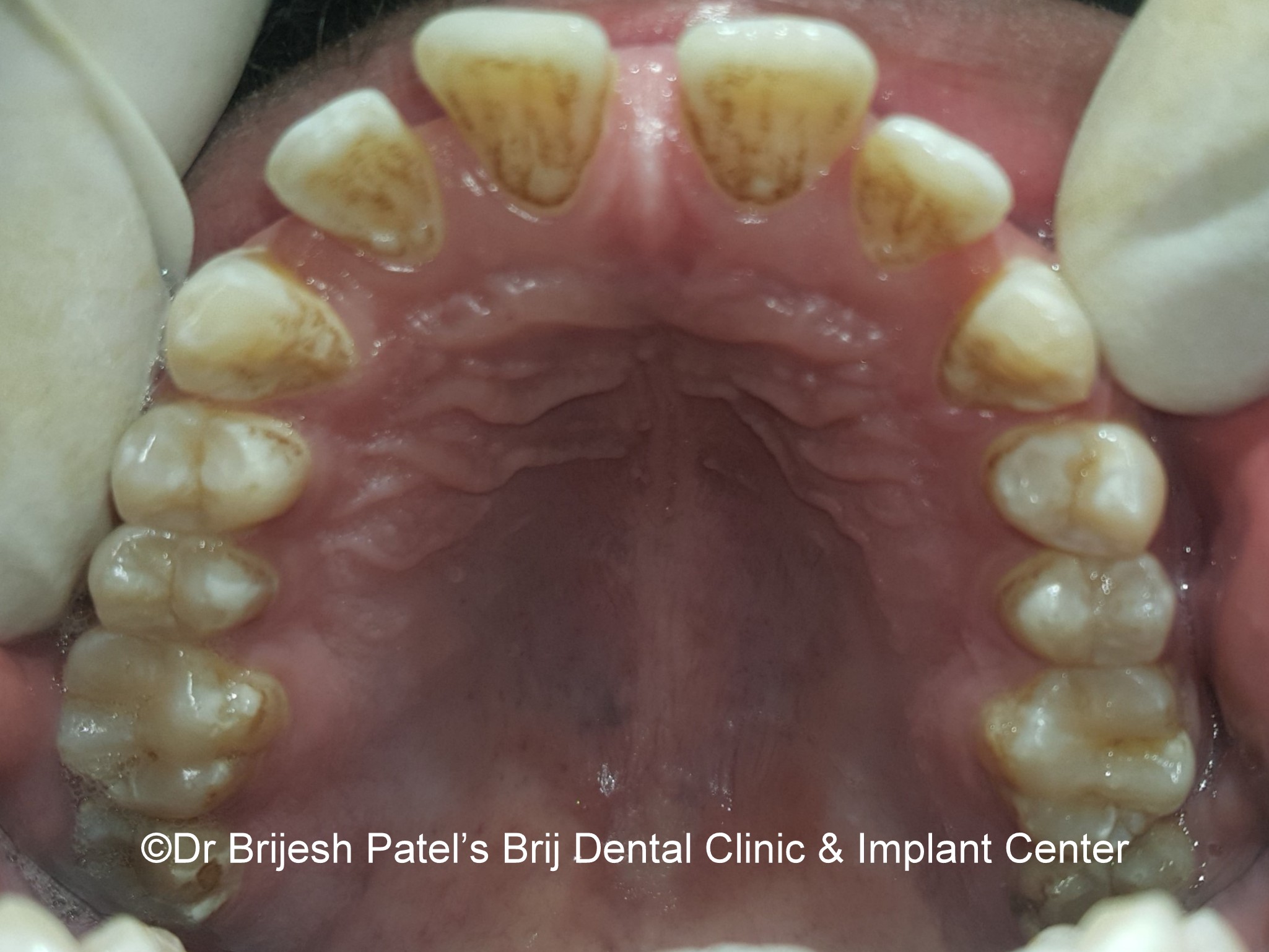 Gap and proclined teeth before treatment