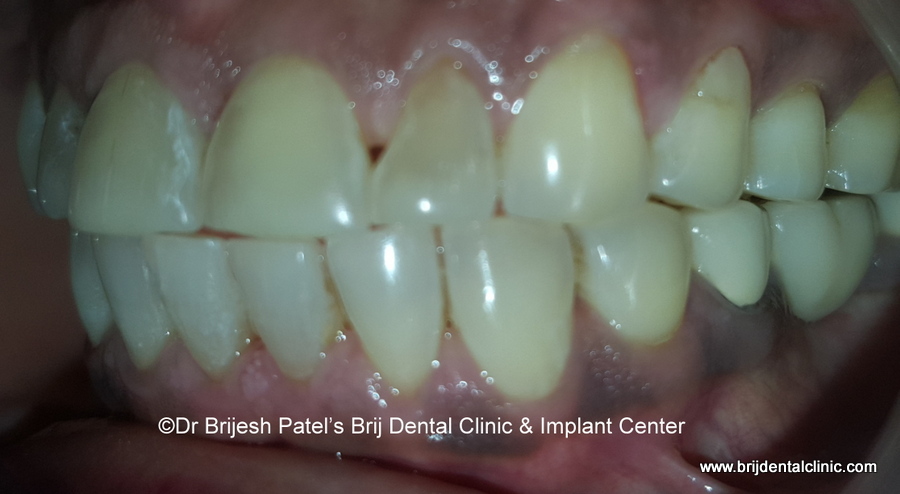 Left side space closed, Alignment after aligners
