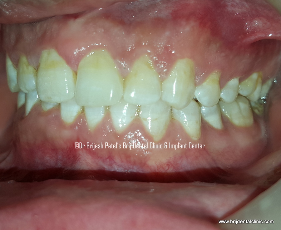 After treatment of Clear Aligner no braces, Results Left side