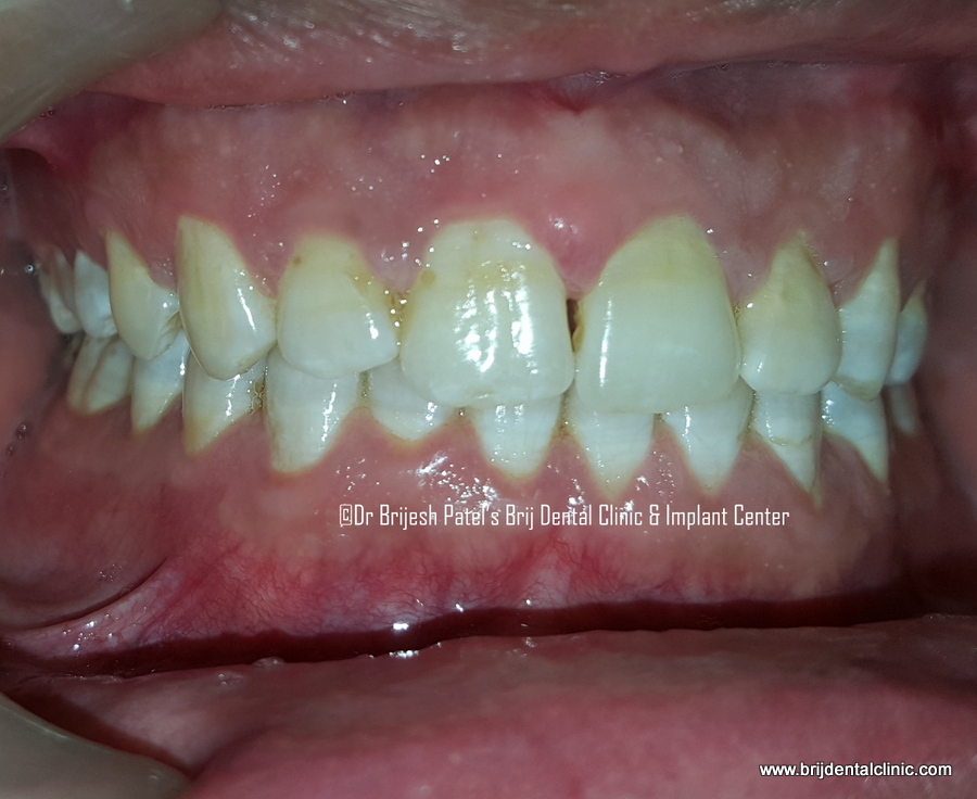 After treatment of Clear Aligner no braces, Results RT side