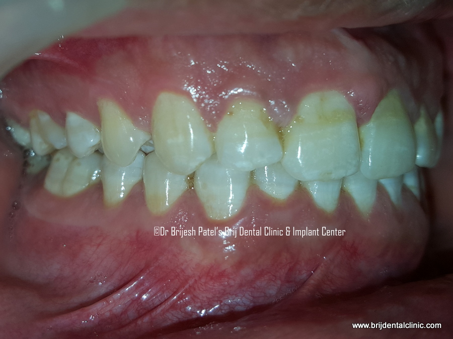After treatment of Clear Aligner no braces, Results Right side