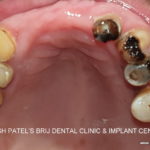 Upper Jaw shows Carious Teeth, Missing teeth