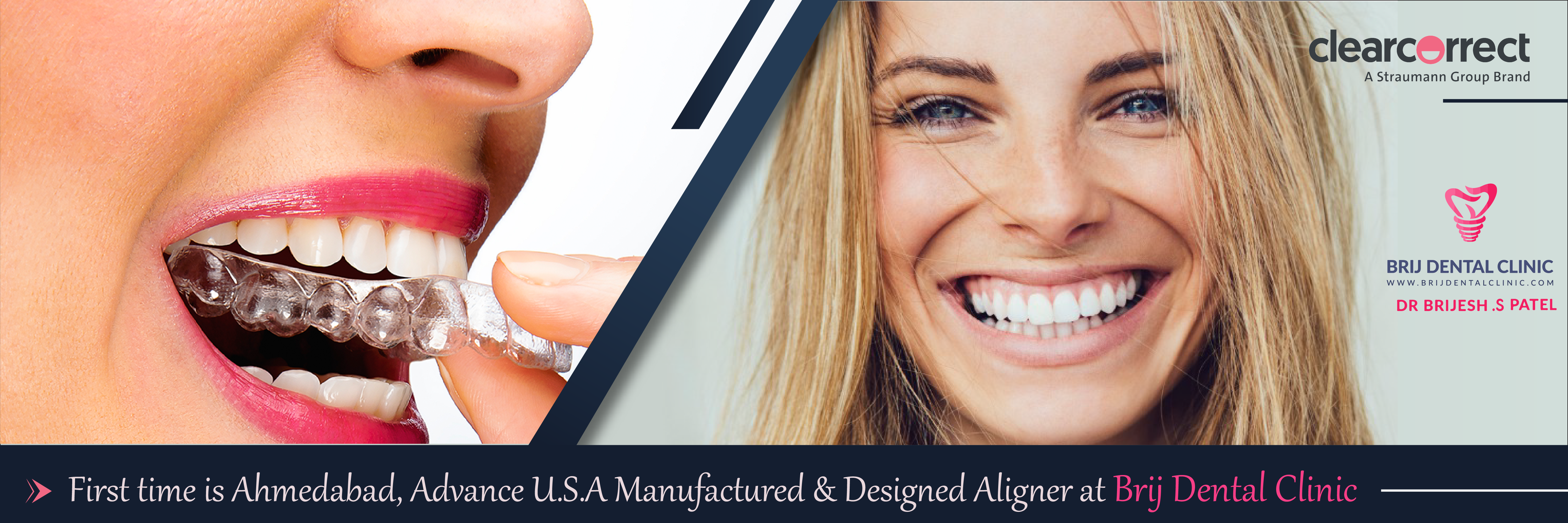 Best Clear Aligner Technology in Ahmedabad india.