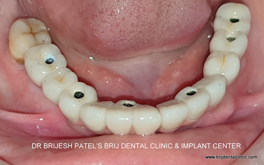 CEMENT RETAINED PROSTHESIS FITTING