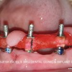 IMPLANT CONNECTED JIG TRIAL TAKEN