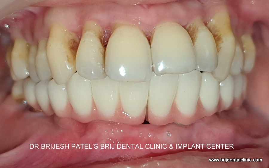 OCCLUSION AFTER IMPLANT PLACEMENT