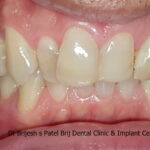 Before Treatment with Deep bite and irregular teeth