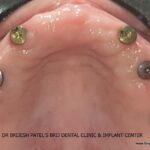 Healing Abutments on Maxillary Dental Implants After Painless Dental Implant Surgery