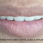 mile After Full mouth ceramic teeth on implants, Ahmedabad, India.