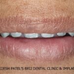 Smile with metal Trial on Dental Implants, Ahmedabad, India.