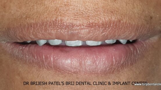 Smile with metal Trial on Dental Implants Smile with metal Trial on Dental Implants, Ahmedabad, India.