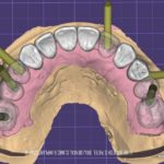 CAD CAM EXOCAD DESIGN FOR IMPLANT PROSTHETIC
