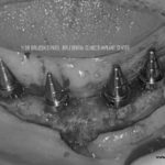 LOWER JAW PARALLEL IMPLANTS