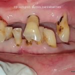 Before treatment loose and mobile teeth