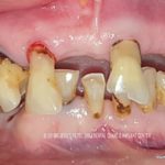 Before treatment weak and mobile teeth