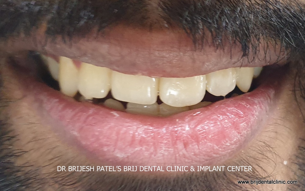 After Braces treatment results in ahmedabad india