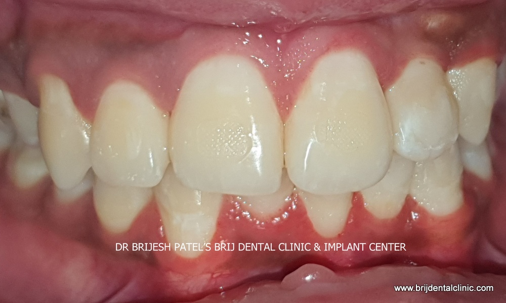 After advance Braces treatment results, Brij Dental ahmedabad
