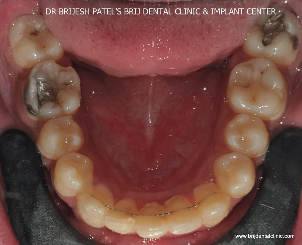 After treatment corrected and aligned teeth with lower jaw