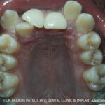 Before treatment Irregular teeth and deep bite upper jaw