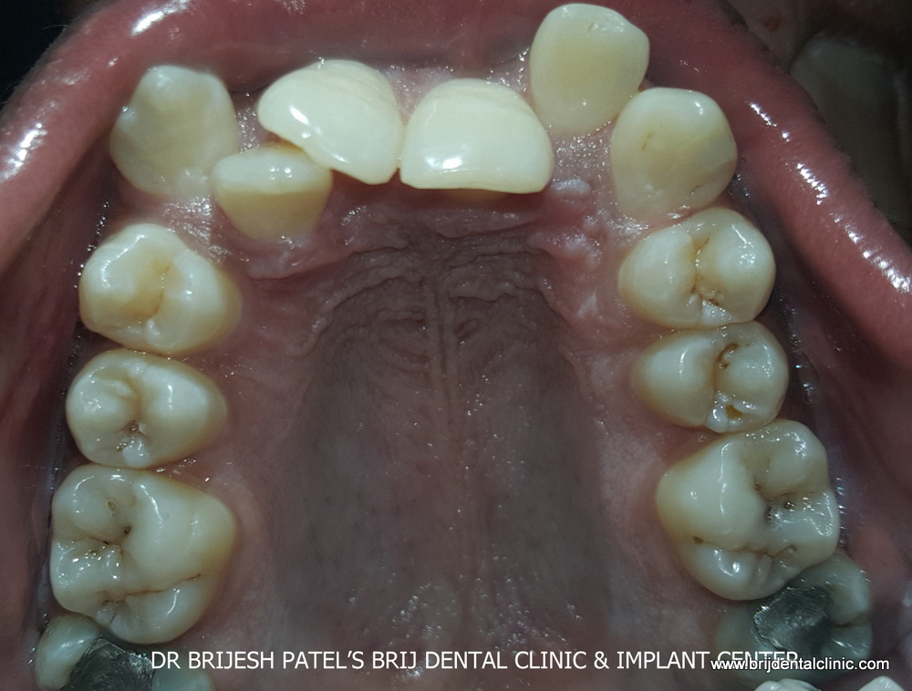Before treatment Irregular teeth and deep bite upper jaw