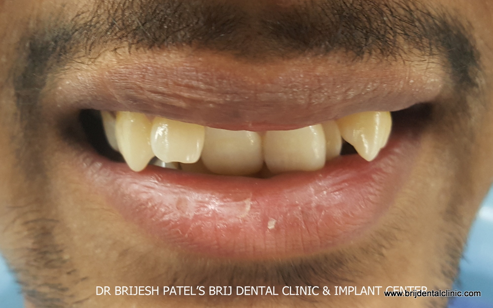 Before treatment smile with irregular teeth