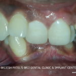 Irregular teeth and bite before treatment