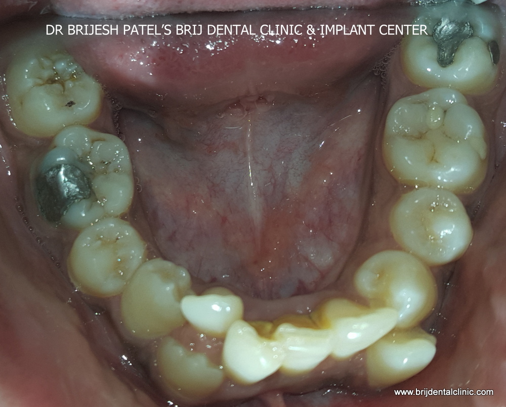 crowding and irregular lower teeth before braces