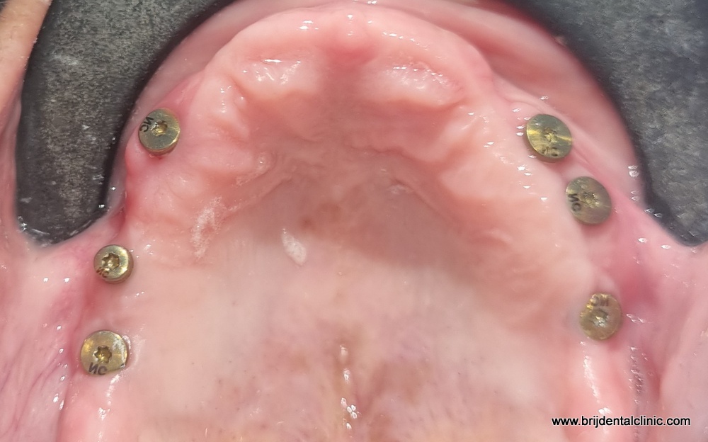 All On Six Straumann Implants Upper Jaw