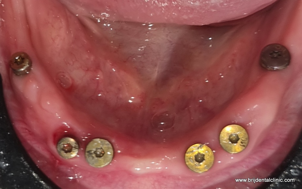All On six Straumann Implants Lower Jaw