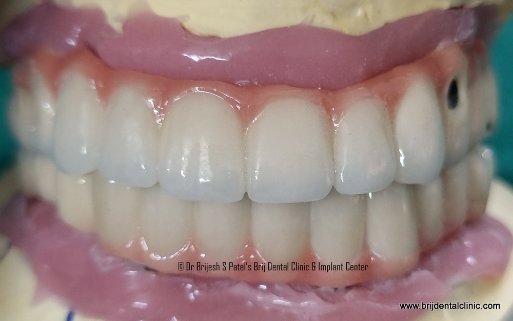 Full Mouth Ceramic Teeth on Straumann Dental Implants