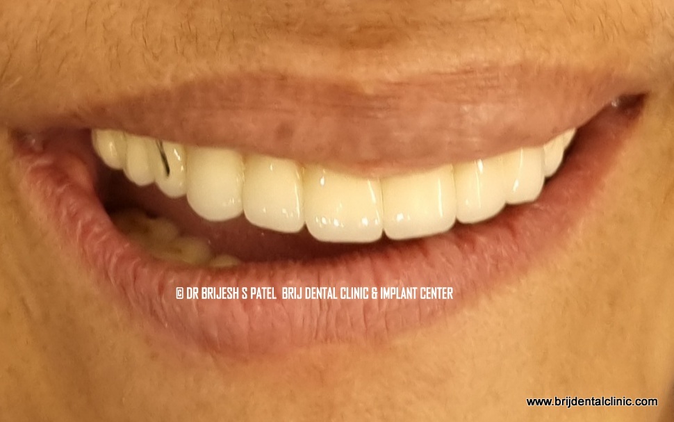 Smile After Full Mouth Rehabilitation with Dental Implants