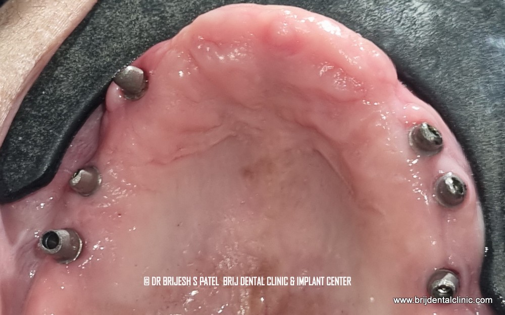Straumann BLT RC abutments on Six Dental Implants Upper Jaw